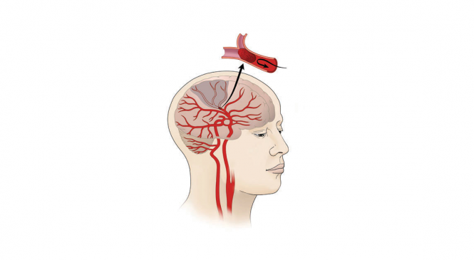 मस्तिष्काघात : ‘समयमै विशेषज्ञ उपचार पाए पूर्ववत् अवस्थामा फर्किन सकिन्छ’